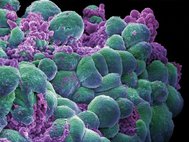 Раковые клетки, электронная микрофотография