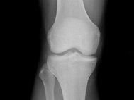 Рентгенограмма колена