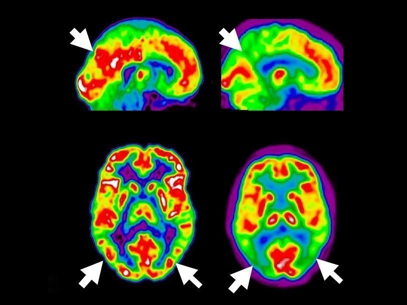Томограмма мозга здорового человека и пациента с болезнью Альцгеймера