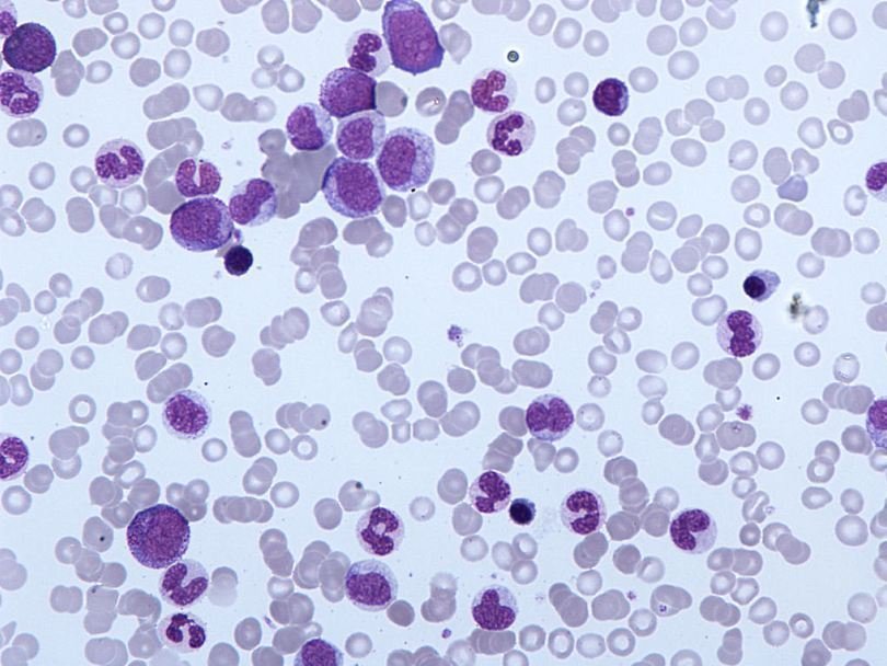 Микропрепарат крови больного хроническим миеломоноцитарным лейкозом