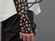 Напечатанная на 3D-принтере «гипсовая повязка»