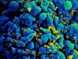 Зараженный ВИЧ Т-лимфоцит человека (растровая электронная микроскопия)