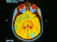 МРТ мозга