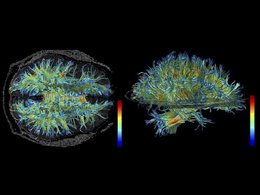 Белое вещество человеческого мозга (магнитно-резонансная томография)