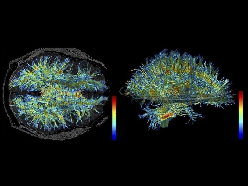 Белое вещество человеческого мозга (магнитно-резонансная томография)
