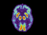 Томограмма мозга пациента с болезнью Альцгеймера
