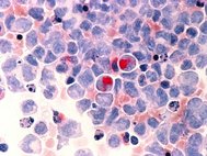 Клетки крови больного лейкемией