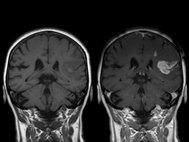 МРТ мозга после инсульта.