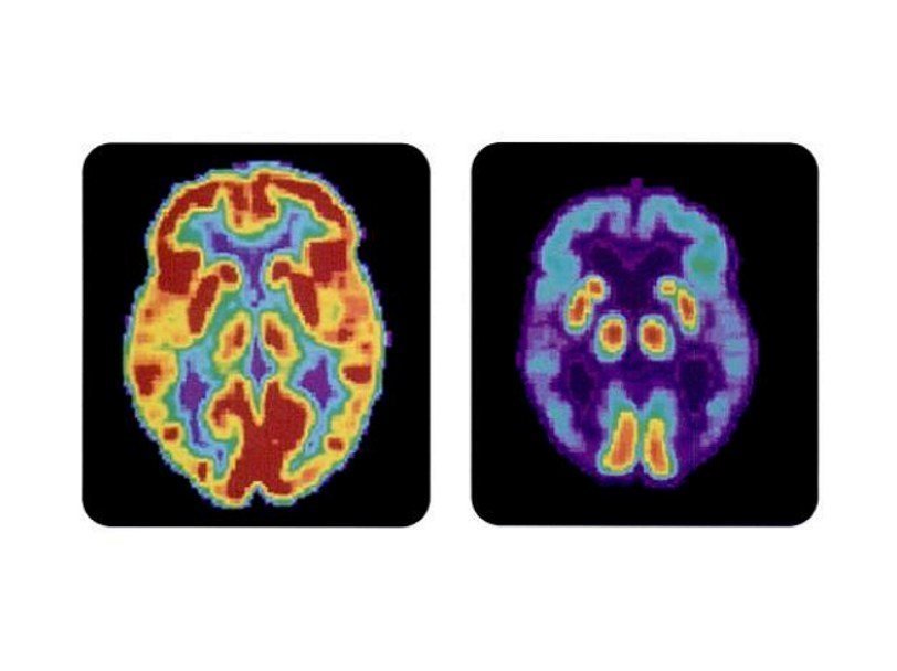 Томограмма здорового мозга и мозга пациента с болезнью Альцгеймера