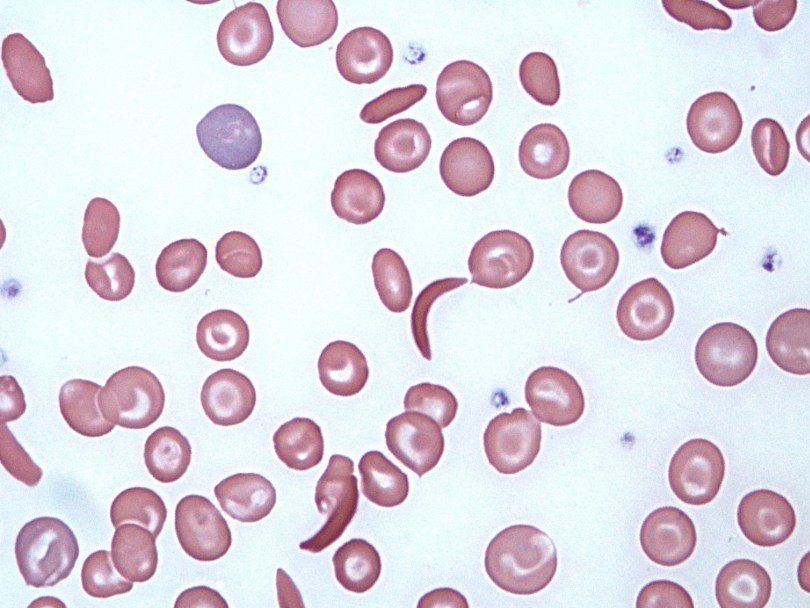 Кровь с серповидными клетками