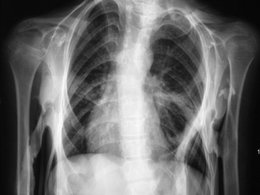 Рентген грудной клетки человека с ФОП
