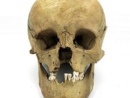 Найденный в центральной Венгрии череп мужчины, родившегося с тяжелой расщелиной неба