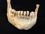 Ученые обнаружили в составе отвердевшего зубного налета бета-лактоглобулин