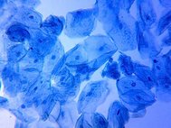 Лечебным средством при метгемоглобинии служит вещество под названием метиленовый синий (на фото окрашенные им клетки)