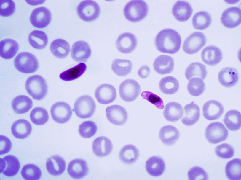Plasmodium falciparum в крови человека