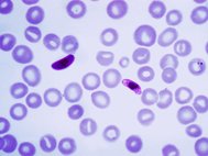 Plasmodium falciparum в крови человека