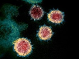 Частицы вызывающего коронавирусную инфекцию вируса под электронным микроскопом