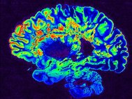 МРТ мозга человека с рассеянным склерозом