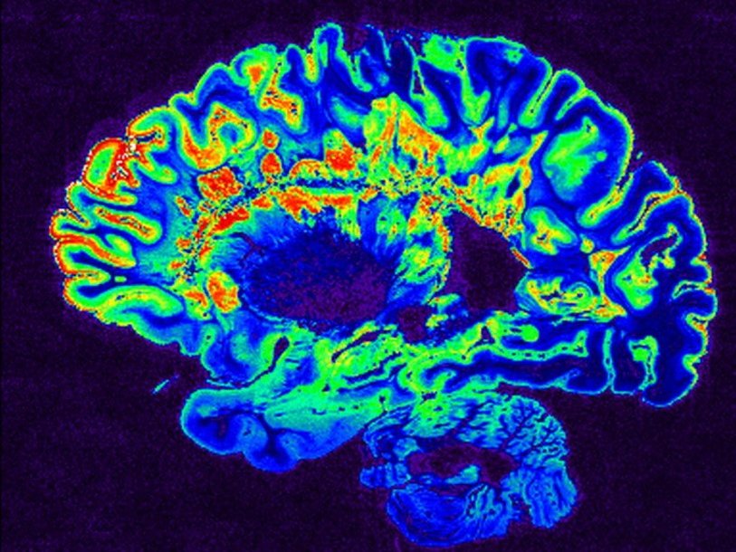МРТ мозга человека с рассеянным склерозом