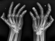 Рентгенограмма рук больного ревматоидным артритом