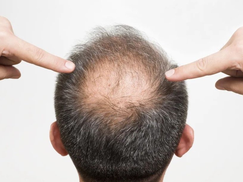 Жуткое выпадение волос может свидетельствовать о какой нибудь болезни