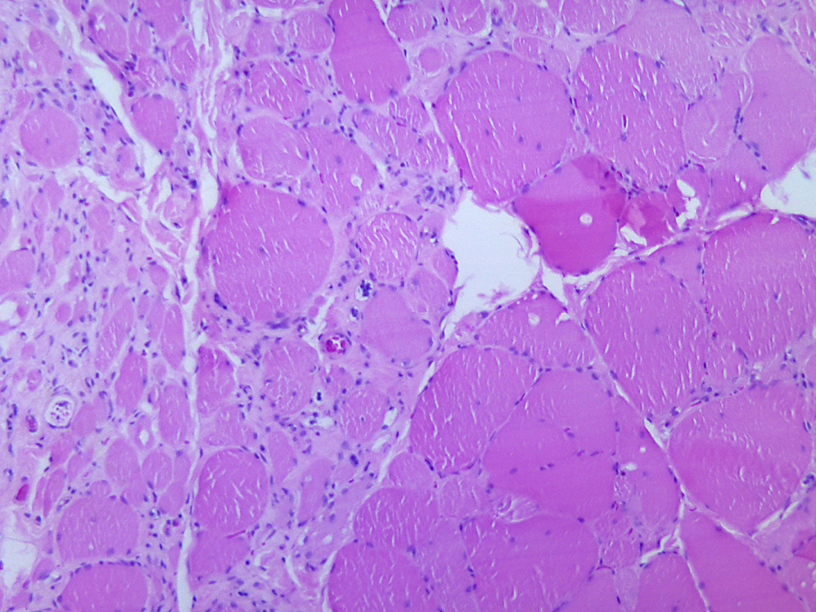 Полиомиелит-мутант