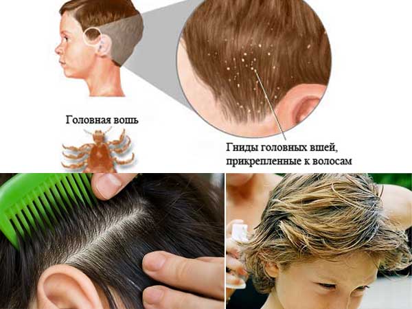 Педикулез: враг у ворот